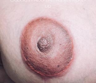 Unmittelbar nach der Behandlung